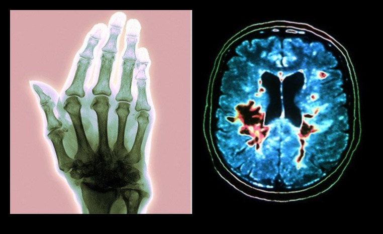 Paleo un autoimūnas ādas stāvokļi: saišu izpēte